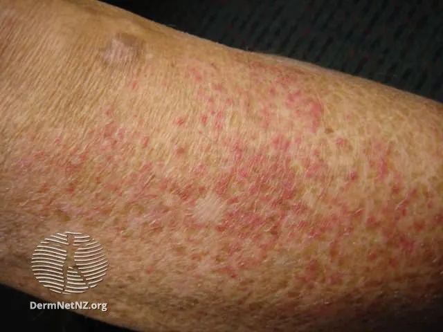 Eczema craquelé
