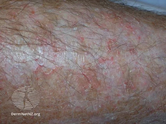 Eczema craquelé