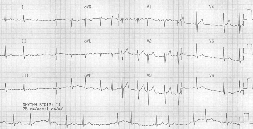 ECG showing atrial fibrillation with coarse fibrillatory waves