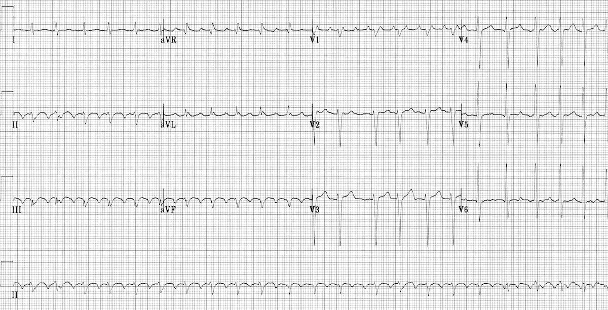 ECG showing atrial flutter with saw-tooth flutter waves