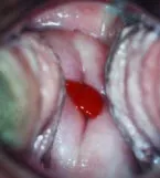 Cervical polyp