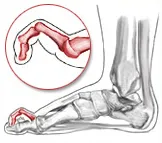 Claw toe