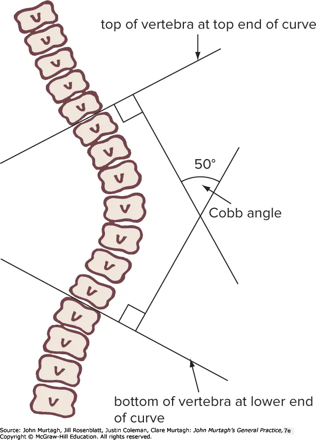 Cobb angle measurement — Murtagh figure 37.7