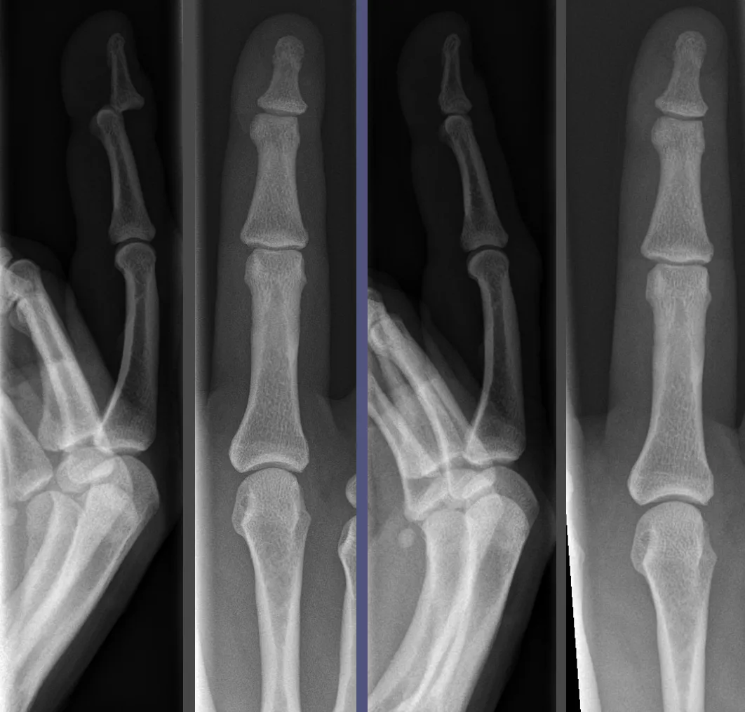 DIP joint dislocation of the third finger before (left) and after (right) reduction — note how little the dislocation shows on the AP view compared with the lateral