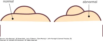 Forward bend test — Murtagh figure 37.6