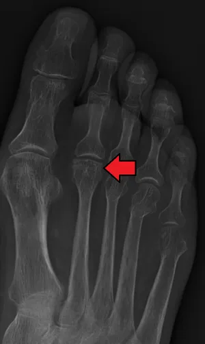 Freiberg disease — 2nd metatarsal head