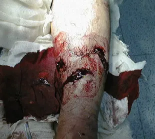 Open leg fracture, Gustilo type 2 — wound over 1 cm with moderate soft-tissue damage and visible fracture
