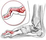 Hammer toe
