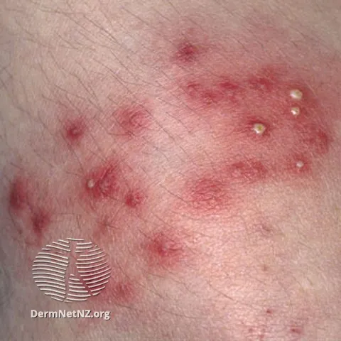 Superficial bacterial folliculitis