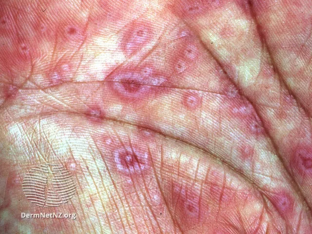 Target lesions