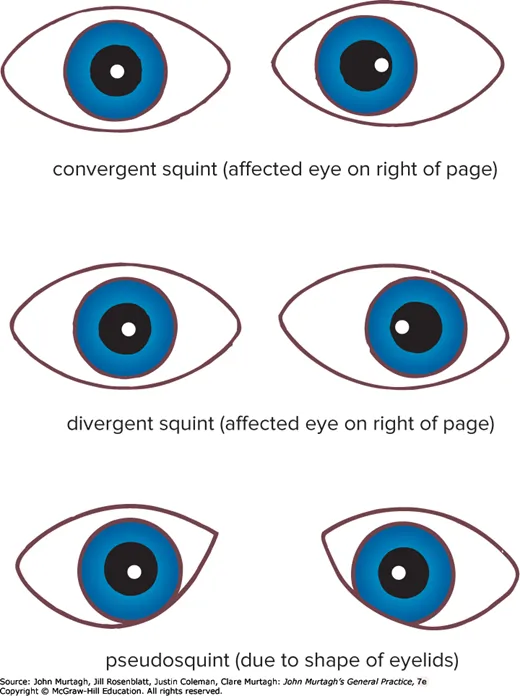 Convergent squint, divergent squint, and pseudosquint (due to eyelid shape)