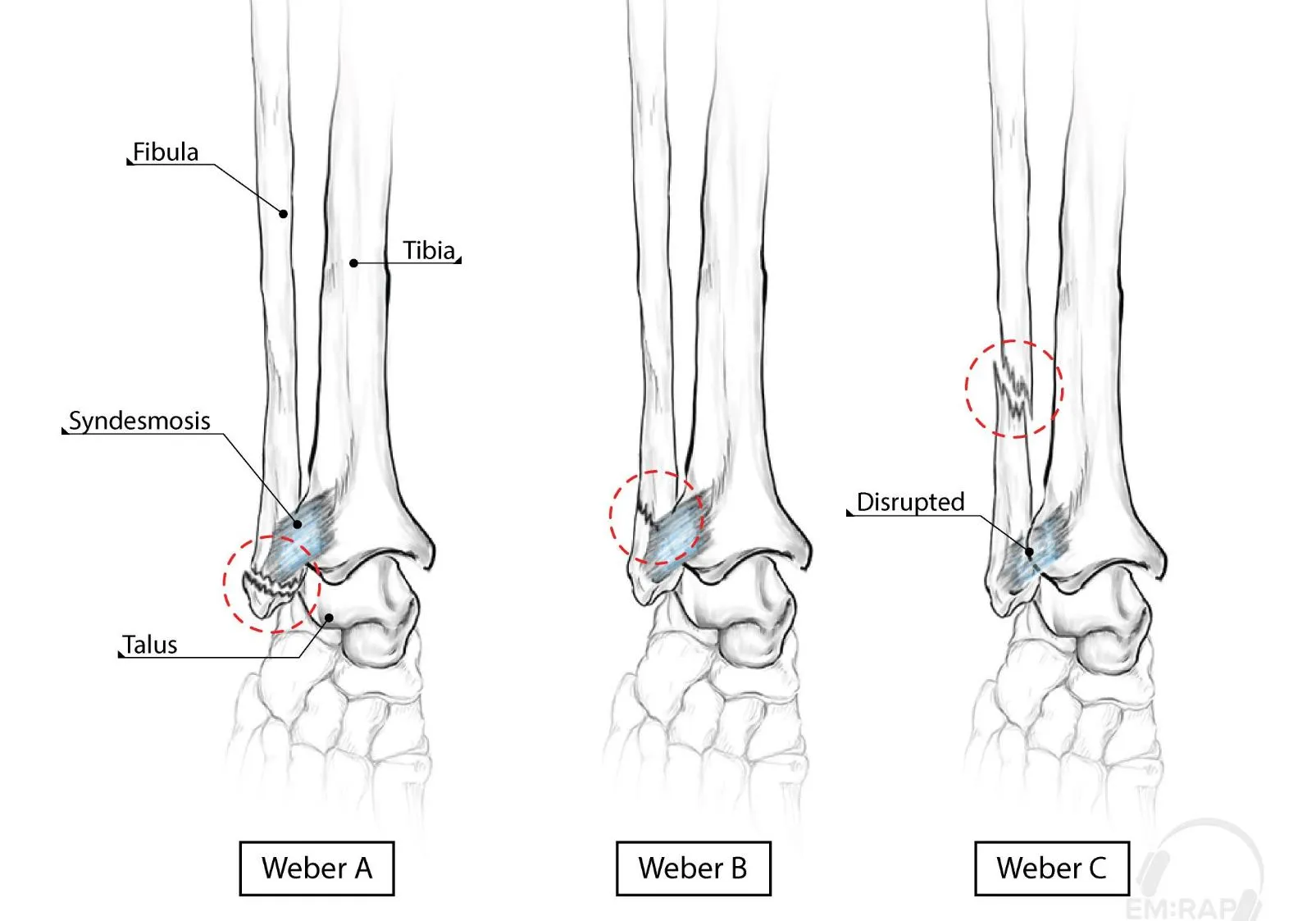 Weber classification of ankle fracture