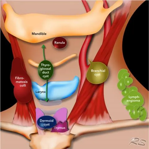 Midline and lateral neck mass differential