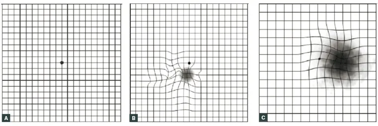 Amsler grid: (A) normal, (B) small scotoma with surrounding metamorphopsia, (C) large scotoma encroaching central fixation