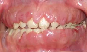 Gingival enlargement in acute myeloid leukaemia