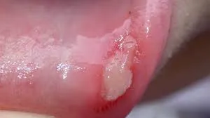Behcet's Disease