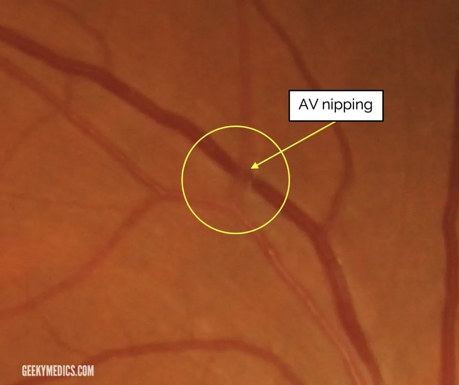 Hypertensive retinopathy