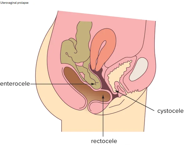 Prolapse examination