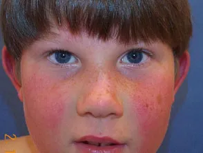 Fifth disease