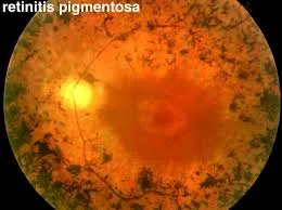 Fundus photo of a patient with retinitis pigmentosa