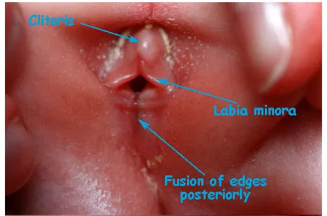 Labial adhesions