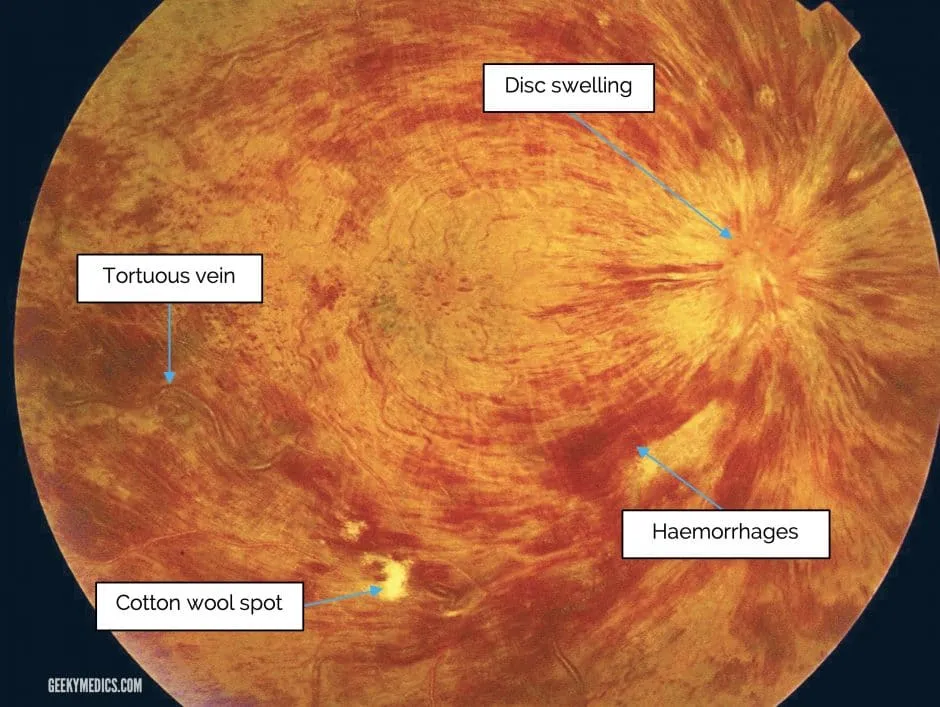 Central retinal vein occlusion