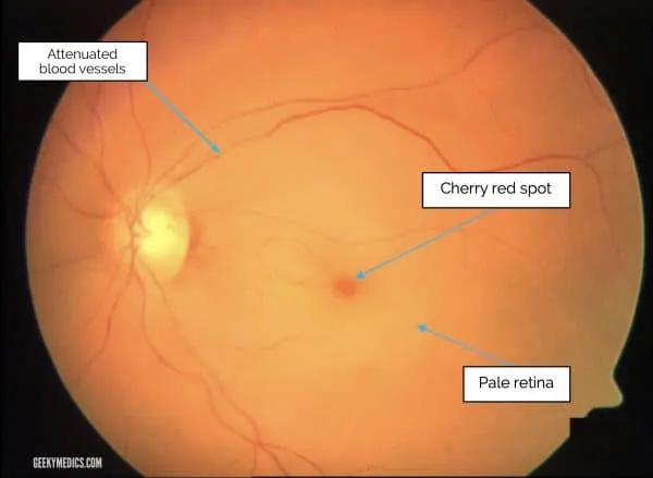 Central retinal artery occlusion