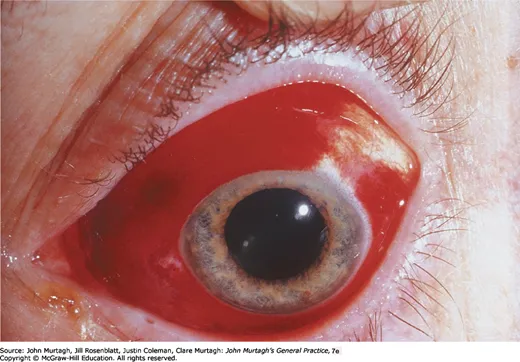 Subconjunctival haemorrhage
