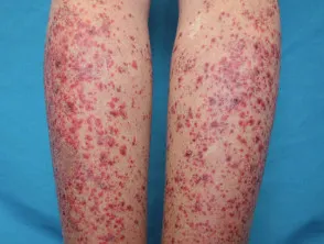 Sjogren vasculitis