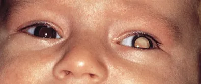 Leukocoria in retinoblastoma