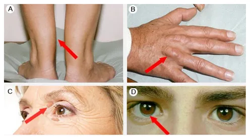 Xanthoma/xanthelasma