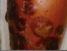 Bullous pemphigoid