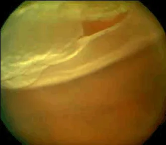 Retinal tear associated with rhegmatogenous retinal detachment