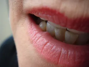 Oral lesion