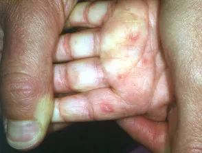 Hand, foot and mouth disease