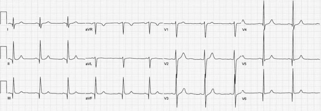 ECG showing dagger-like Q waves in HCM