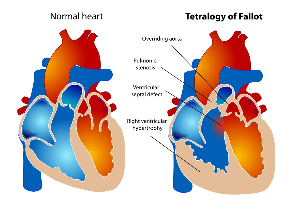 Tetralogy of Fallot anatomy