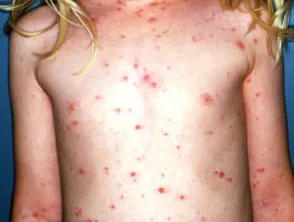 Varicella