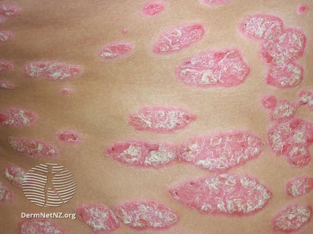 Plaque psoriasis