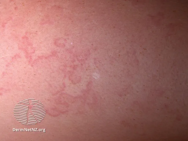 Erythema marginatum
