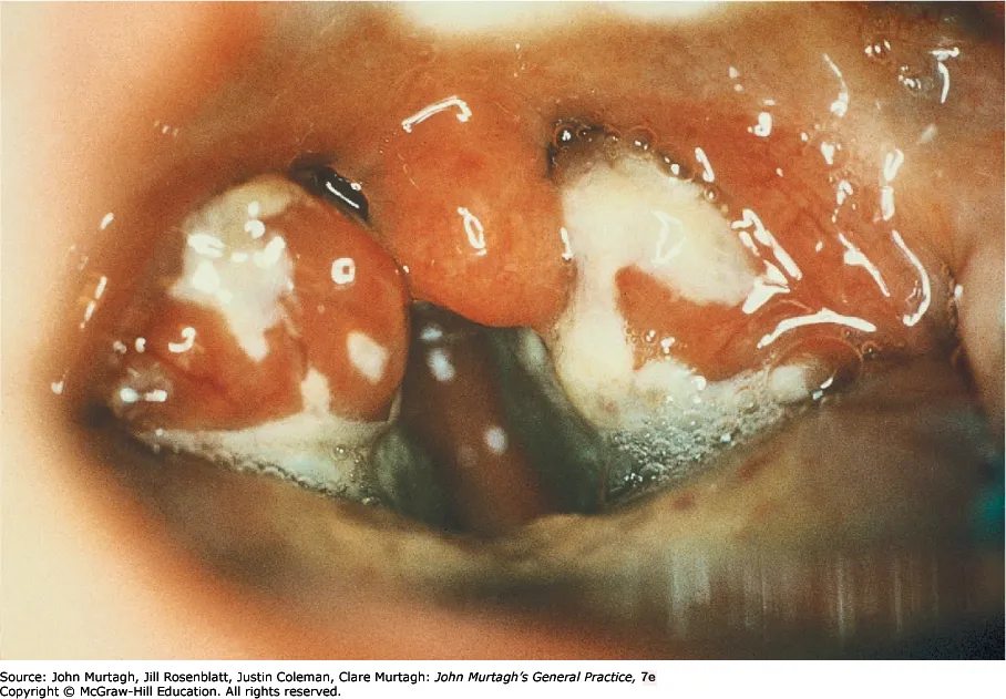 EBV tonsillitis
