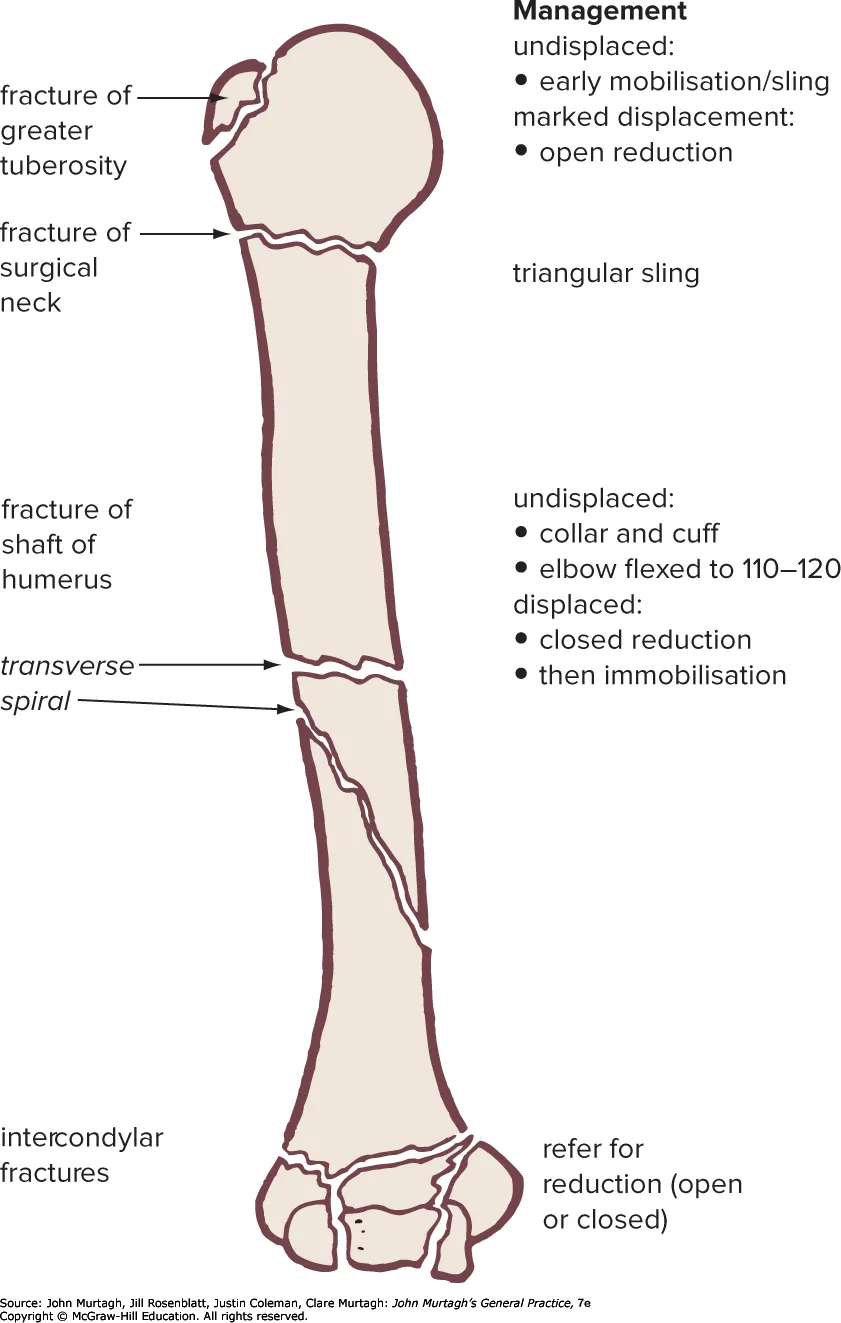 Humeral fracture patterns