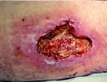 Pyoderma gangrenosum