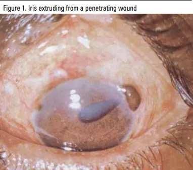Iris extruding from a penetrating wound