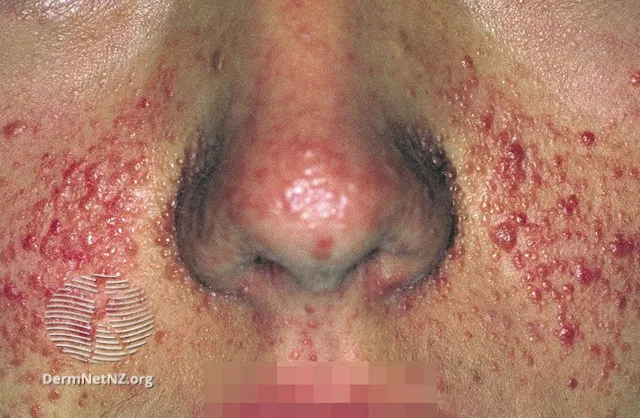 Facial angiofibromas in tuberous sclerosis