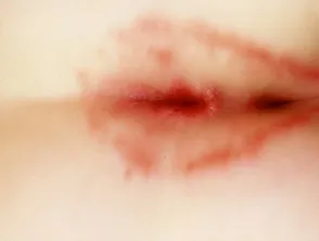 Perianal streptococcal dermatitis