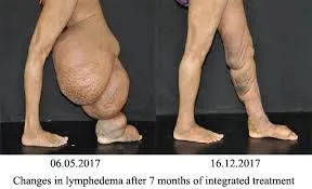 Lymphatic filariasis — lymphoedema