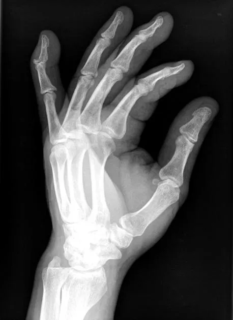 Mallet finger — unable to extend the DIP joint
