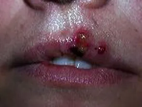 Herpes simplex