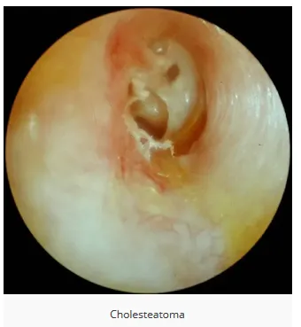 Cholesteatoma otoscopy